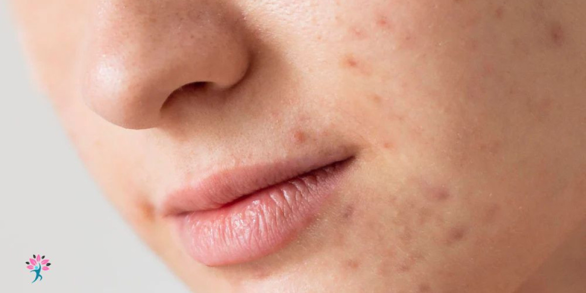 Essential Skincare Tips to Prevent Acne Effectively